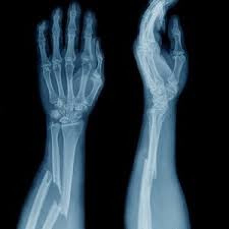 broken bones